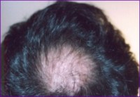 Before hair restoration